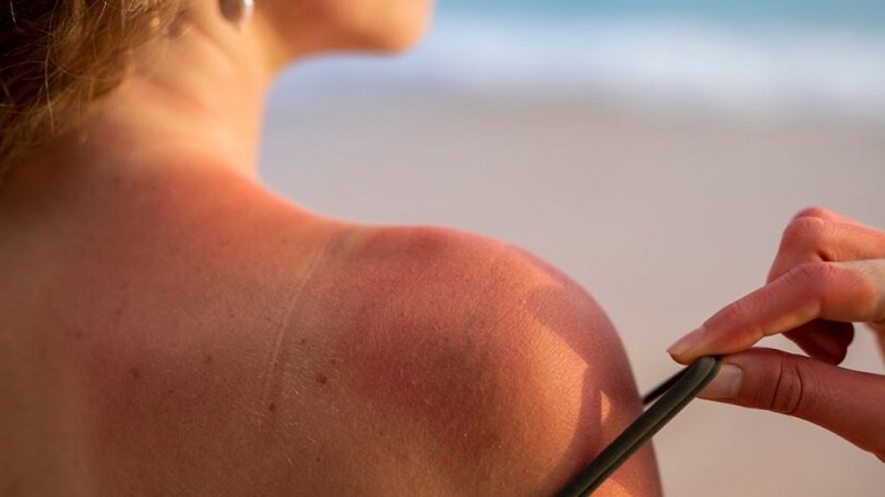 Goodbye Sun Damage: Rejuvenating Your Skin After Sun Exposure